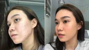 How To Cover Acne Marks/Pimples with No Foundation | Andy Buela (Philippines)