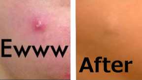 Best Way to Cover a Pimple! Quick Makeup Tip!