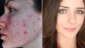 How To Cover Acne & Scars (IF You Want To) | Easy Makeup Transformation Routine