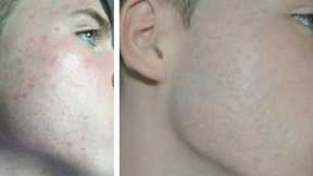 Invisible Makeup Tutorial For Guys - With Acne -