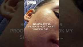 How I CLEARED My TEXTURED SKIN!! How I Got Rid Of Those Tiny Bumps On Skin!!