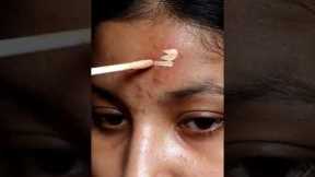 How to hide active  acne / acne marks using make-up .